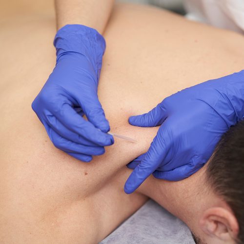 A healthcare professional wearing blue gloves performs acupuncture on a person's shoulder, demonstrating a therapeutic technique in a clinical setting.