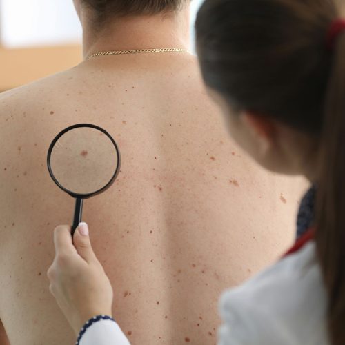 A clinician examines a patient's back using a magnifying glass, focusing on moles and skin texture, in a clinical setting.