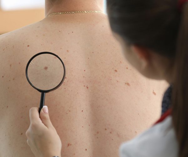 A clinician examines a patient's back using a magnifying glass, focusing on moles and skin texture, in a clinical setting.